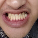 ปัญหาฟันล่างคร่อมฟันบนสามารถเเก้โดยการจัดฟันได้หรือไม่!! ขอเเนะนำ#5คลินิกที่คุณหมอเชี่ยวชาญทางด้านจัดฟันเเละรับเเก้ปัญหาทุกเคส!!!