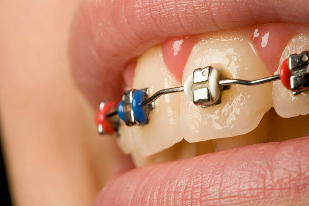 จัดฟันครั้งแรกต้องเตรียมเงินเท่าไหร่ ถึงจะเรียกว่าเซฟสุดๆ ขอแนะนำ #7คลินิกดัดฟันที่แรกเข้าราคาดี๊ดีย์