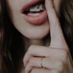 ทำความรู้จักกับการจัดฟันแบบ “ดามอน (Damon)” และแนะนำ #5 คลินิกพร้อมราคา!!