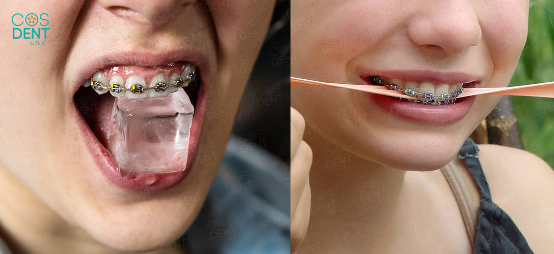 จัดฟันมีกี่แบบ
